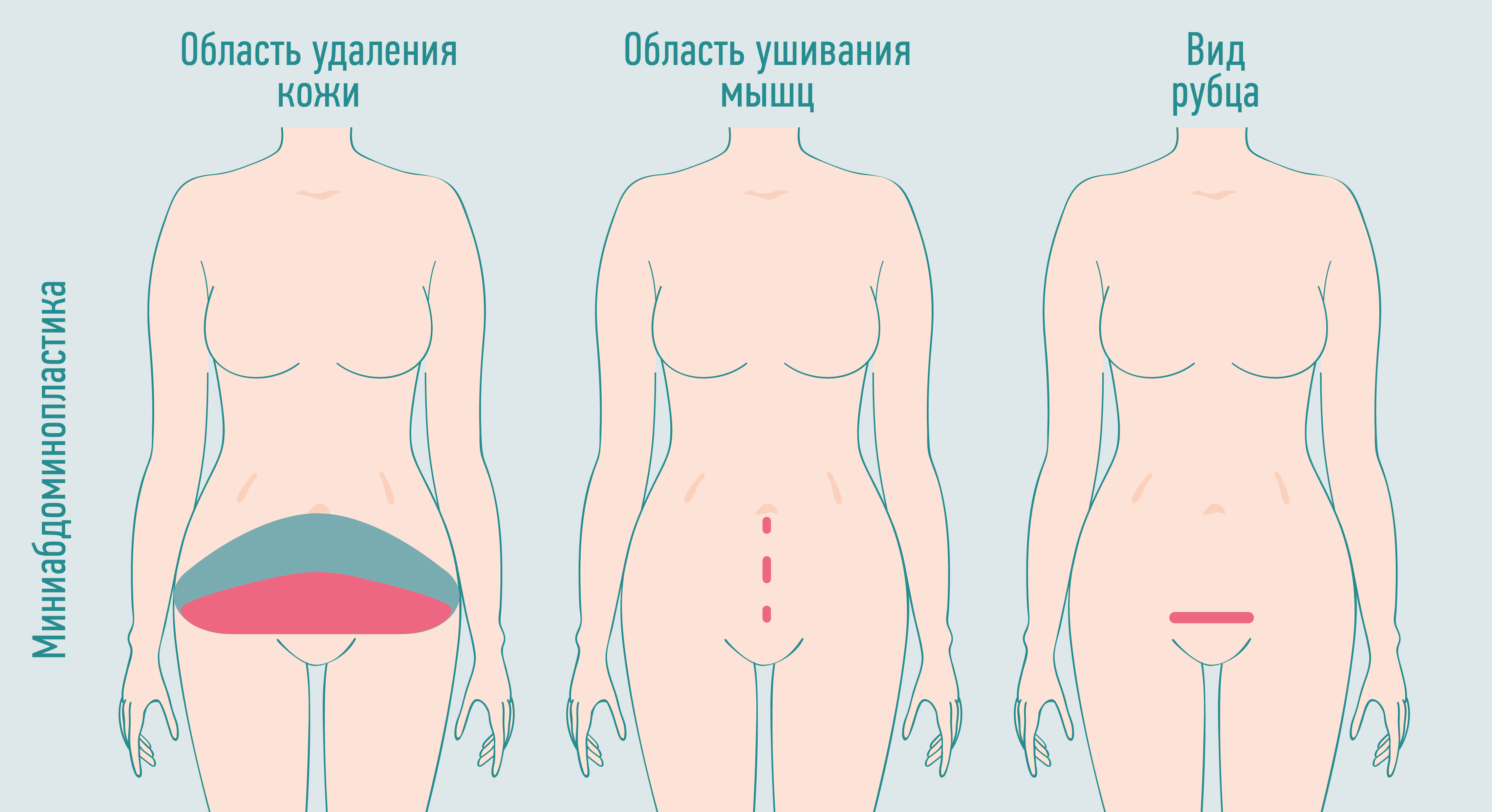 миниабдоминопластика